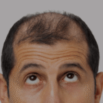 What To Expect From Alopecia Areata Treatment Consultations