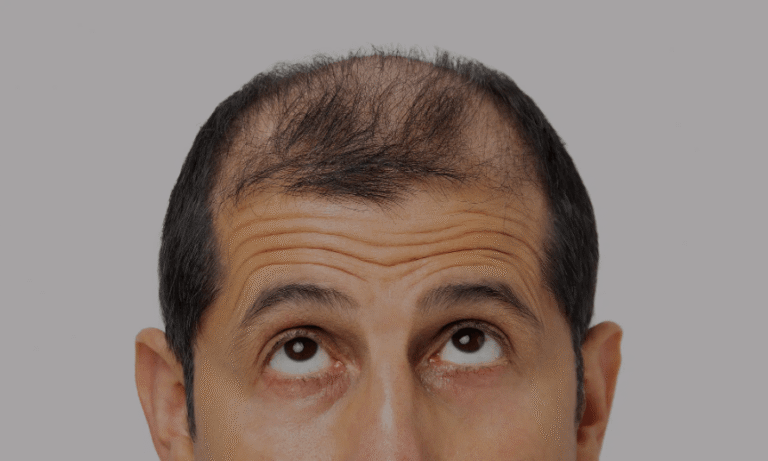 What To Expect From Alopecia Areata Treatment Consultations