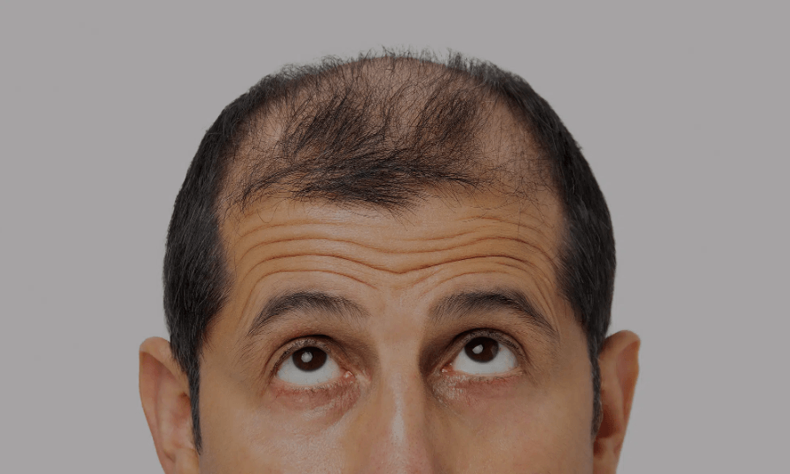 What To Expect From Alopecia Areata Treatment Consultations