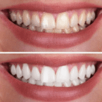 Effective Blancone Teeth Whitening Solutions