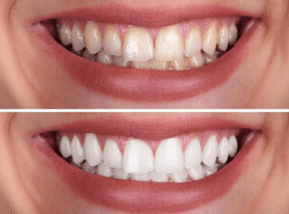 Effective Blancone Teeth Whitening Solutions
