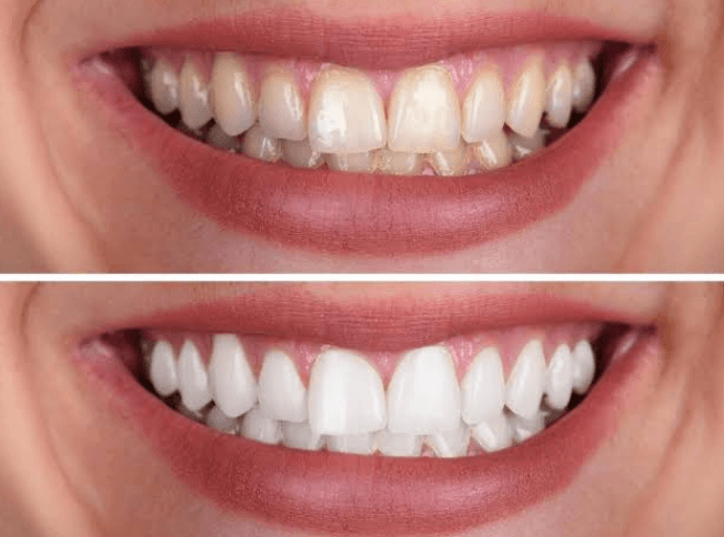 Effective Blancone Teeth Whitening Solutions