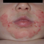 How Nutritional Deficiencies Can Affect Skin Pigmentation in Children