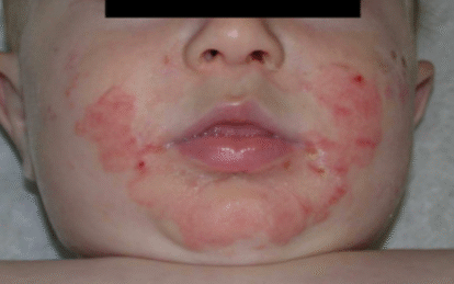 How Nutritional Deficiencies Can Affect Skin Pigmentation in Children