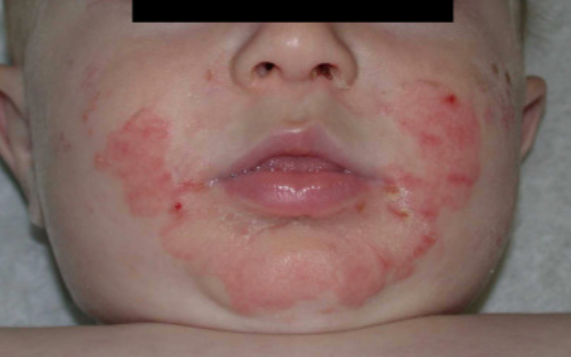 How Nutritional Deficiencies Can Affect Skin Pigmentation in Children